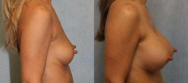 Breast Augmentation Patient 9 Image 2