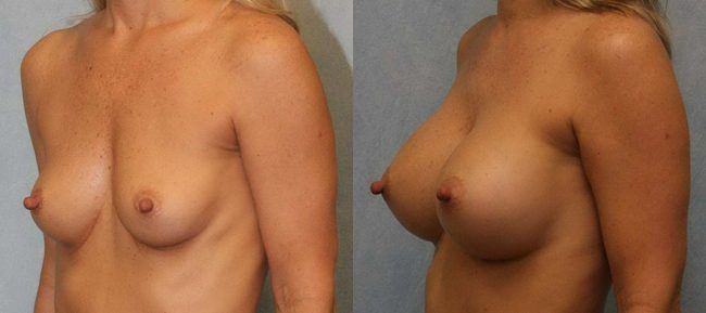 Breast Augmentation Patient 9 Image 1
