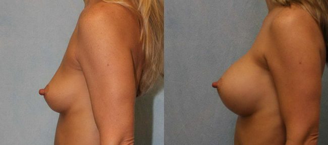 Breast Augmentation Patient 9 Image 0