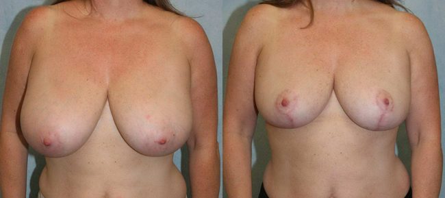 Breast Reduction Patient 4 Image 4