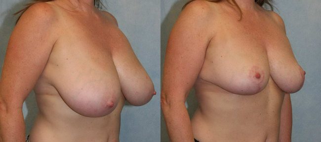 Breast Reduction Patient 4 Image 3