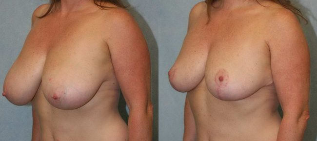 Breast Reduction Patient 4 Image 0