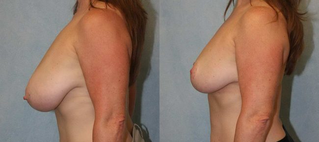 Breast Reduction Patient 4 Image 1