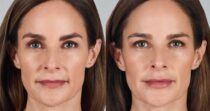 JUVÉDERM® VOLBELLA™ XC Before and After Photo 2