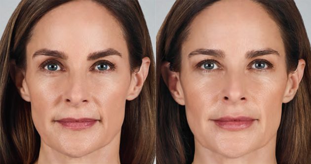 JUVÉDERM® VOLBELLA™ XC Before and After Photo 2