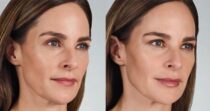 JUVÉDERM® VOLBELLA™ XC Before and After Photo 0