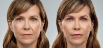 JUVÉDERM® VOLUMA™ XC Before and After Photo 2