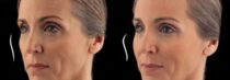 JUVÉDERM® VOLUMA™ XC Before and After Photo 1
