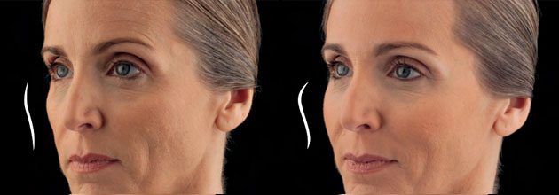 JUVÉDERM® VOLUMA™ XC Before and After Photo 1