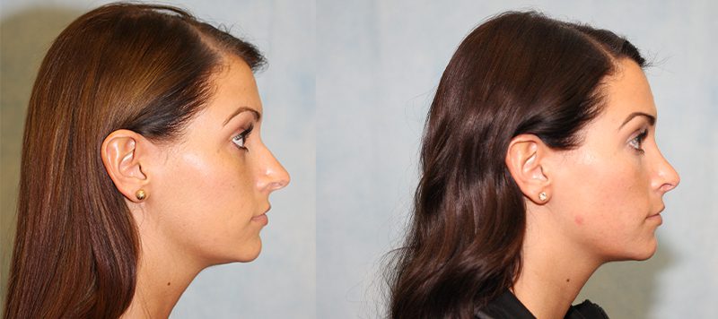 Rhinoplasty Patient 3 Image 0