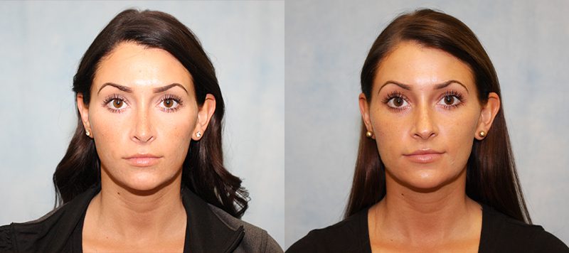 Rhinoplasty Patient 3 Image 2