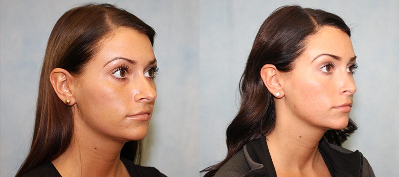 Rhinoplasty Patient 3 Image 1