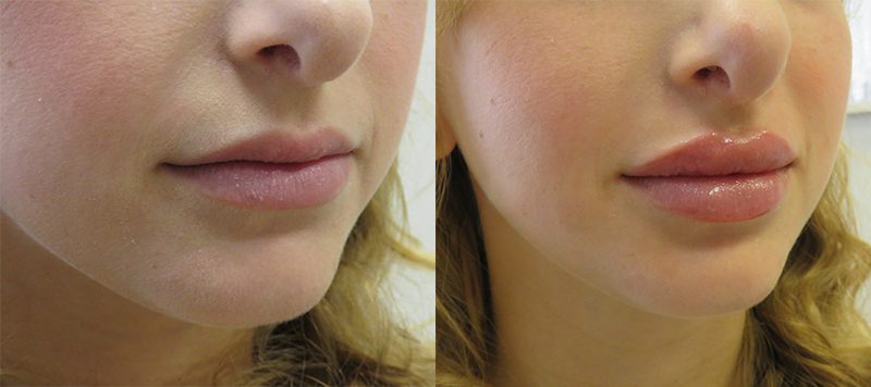 Lip Filler Patient 1 Image 0