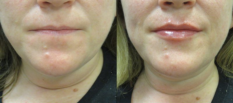 Lip Filler Patient 2 Image 0