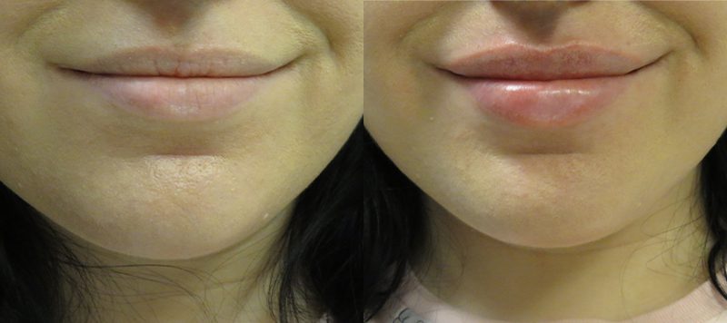 Lip Filler Patient 4 Image 0