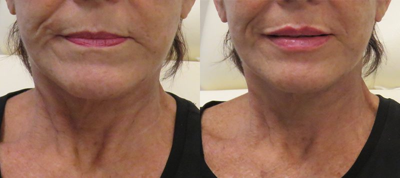 Lip Filler Patient 3 Image 0