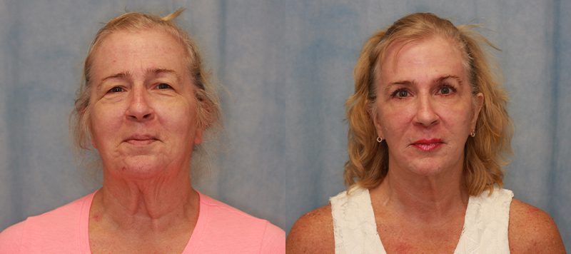 Facelift Patient 10 Image 0