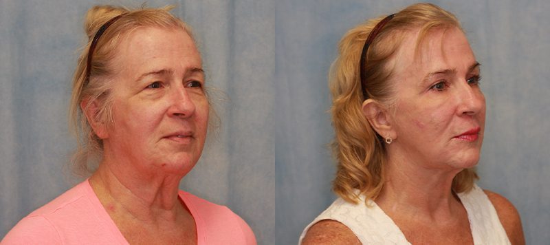 Facelift Patient 10 Image 1