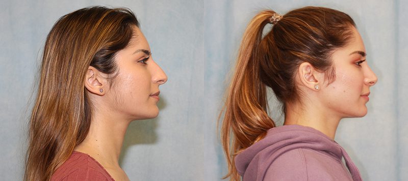 Rhinoplasty Patient 2 Image 1