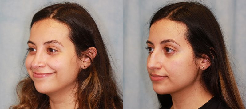 Rhinoplasty Patient 1 Image 1