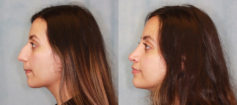 Rhinoplasty Patient 1 Image 0