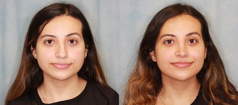 Rhinoplasty Patient 1 Image 2