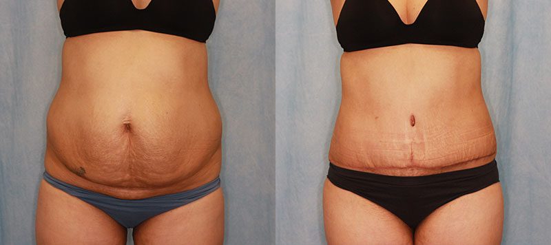 Abdominoplasty Patient 17 Image 0