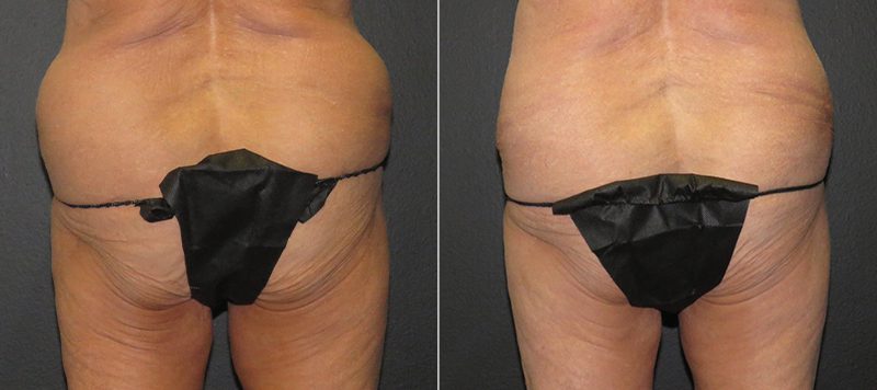 CoolSculpting Patient 6 Image 0