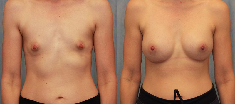 Breast Augmentation Patient 1 Image 0