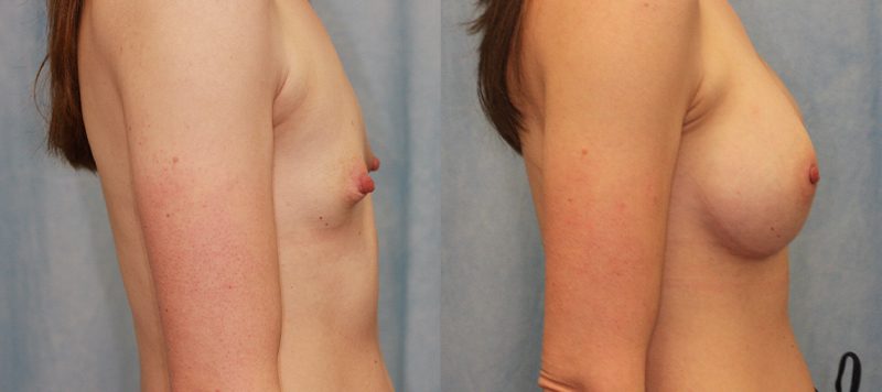 Breast Augmentation Patient 1 Image 1