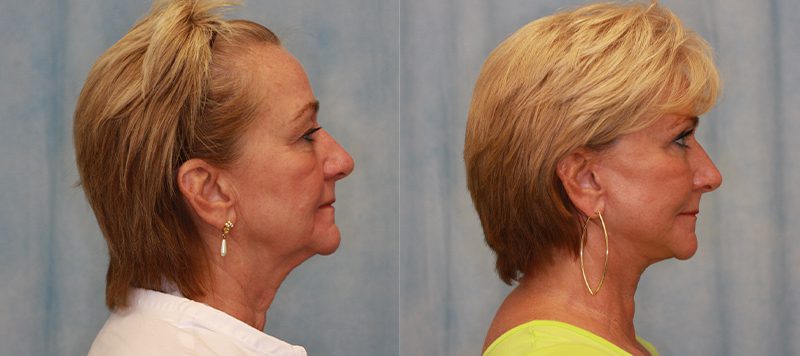 Facelift Patient 7 Image 0