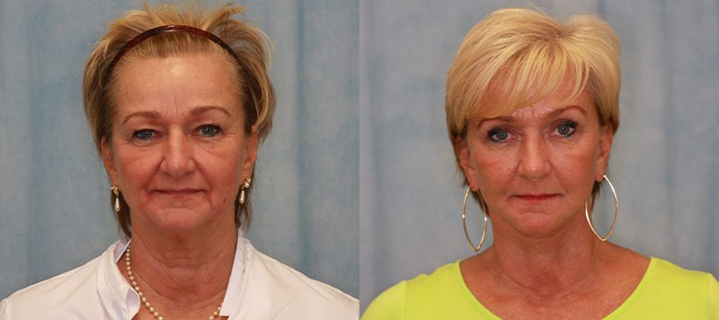 Facelift Patient 7 Image 1