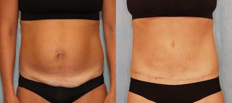 Abdominoplasty Patient 2 Image 0