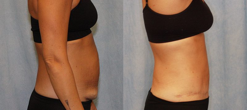 Abdominoplasty Patient 2 Image 2