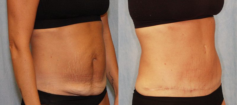 Abdominoplasty Patient 2 Image 1