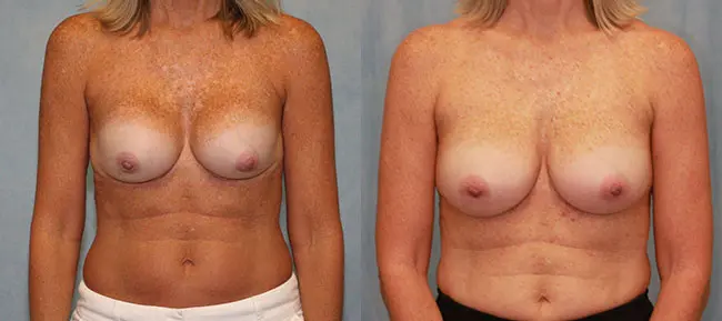 Breast Augmentation Revision Patient 2 Image 0
