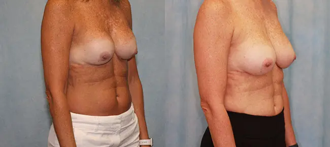 Breast Augmentation Revision Patient 2 Image 2