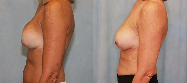 Breast Augmentation Revision Patient 2 Image 1