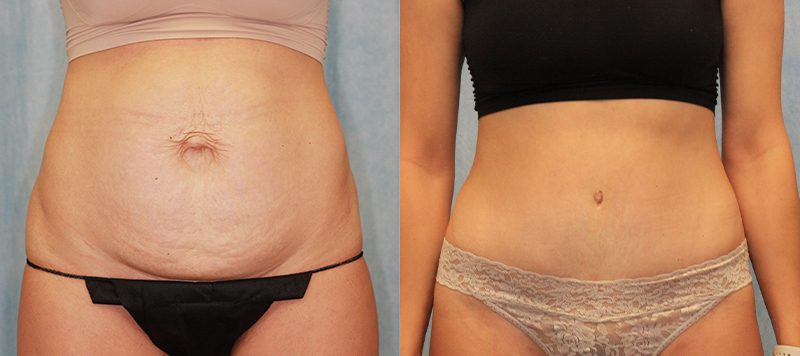 Abdominoplasty Patient 3 Image 0