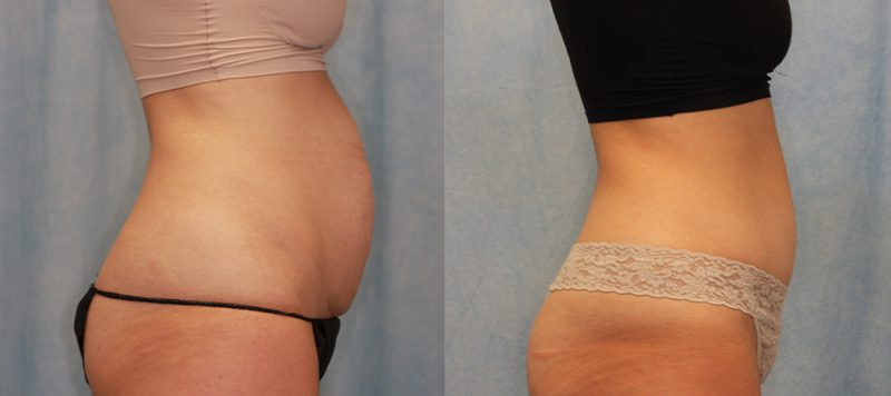 Abdominoplasty Patient 3 Image 2