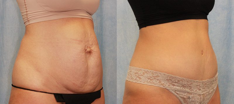 Abdominoplasty Patient 3 Image 1