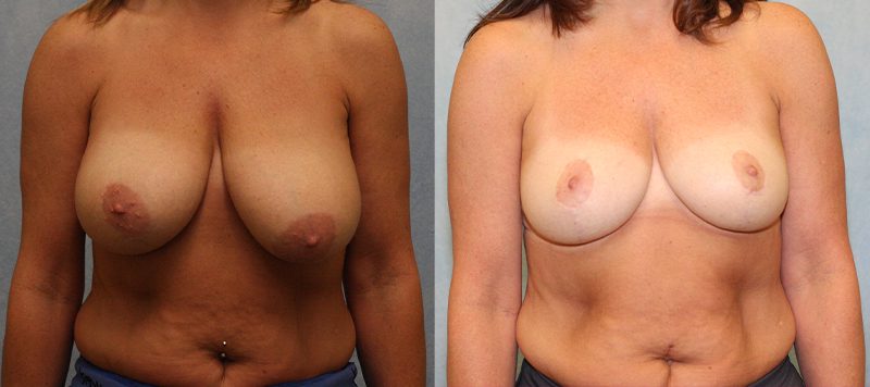 Breast Lift Patient 1 Image 0