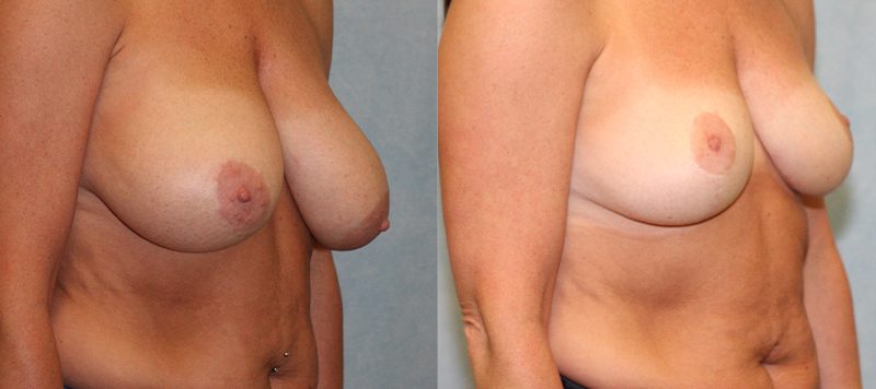 Breast Lift Patient 1 Image 2