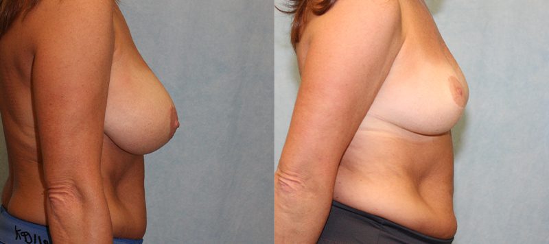 Breast Lift Patient 1 Image 1