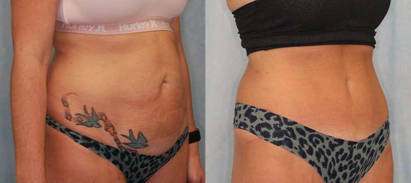 Abdominoplasty Patient 4 Image 0