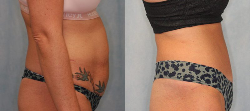 Abdominoplasty Patient 4 Image 2