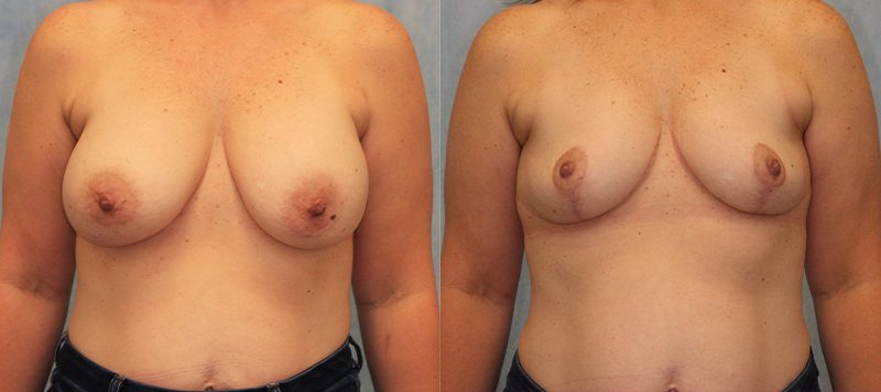 Breast Lift Patient 2 Image 0