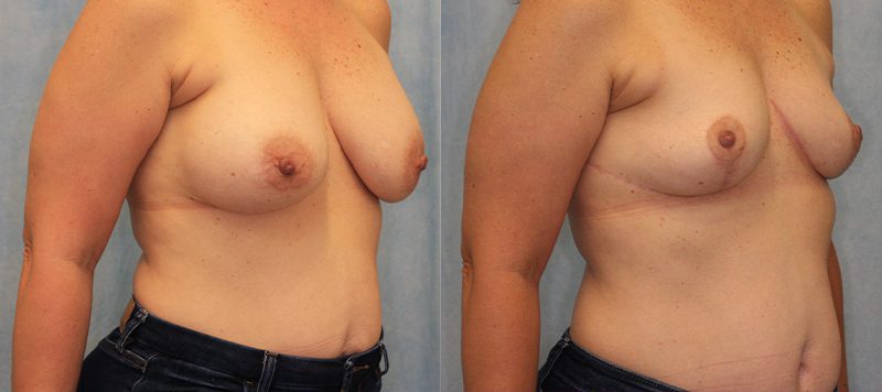 Breast Lift Patient 2 Image 2