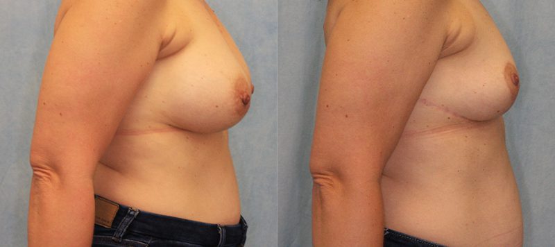 Breast Lift Patient 2 Image 1