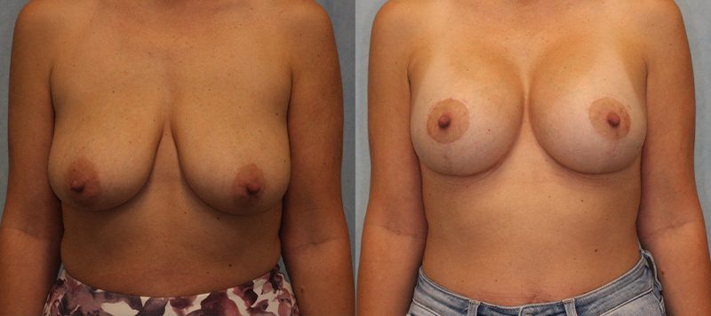 Breast lift Patient 3 Image 0